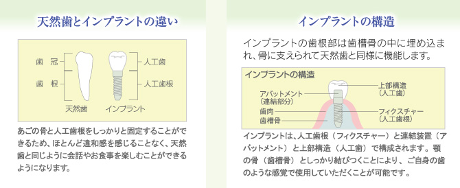 天然歯とインプラントの違い／インプラントの構造