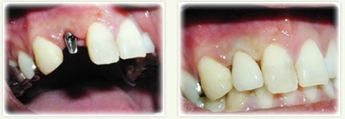 上の歯にインプラントを埋入した症例紹介