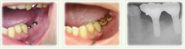 奥歯2本をインプラントに埋入した症例紹介