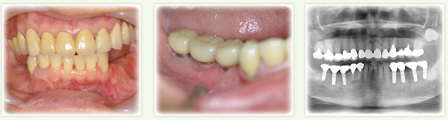 両奥歯にインプラントを埋入した症例紹介