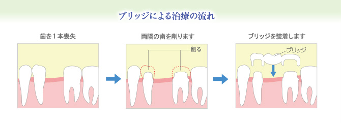 ブリッジによる治療の流れ