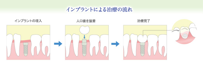 インプラントによる治療の流れ