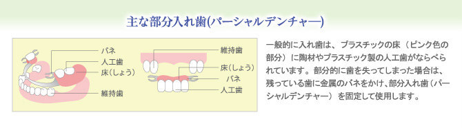 主な部分入れ歯(パーシャルデンチャ―)