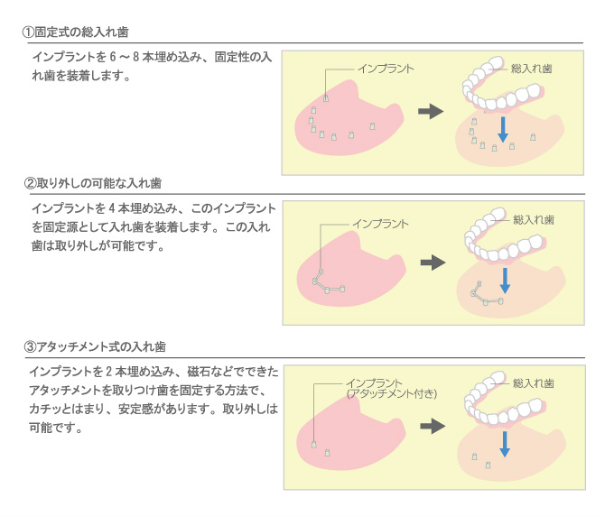 インプラントの場合