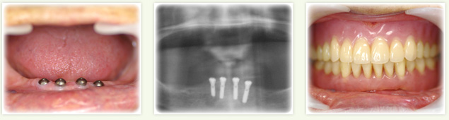 アタッチメント（マグネット）義歯を装着した症例紹介