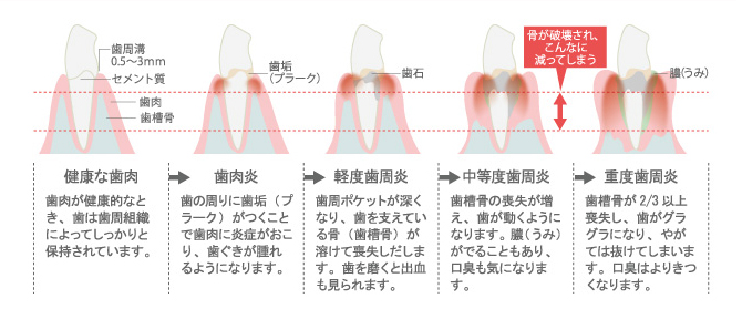 歯周病の進行