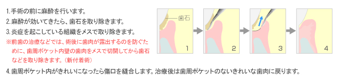 歯周ポケット掻爬術（新付着術）