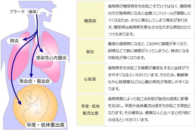 全身の病気と歯周病の関係性