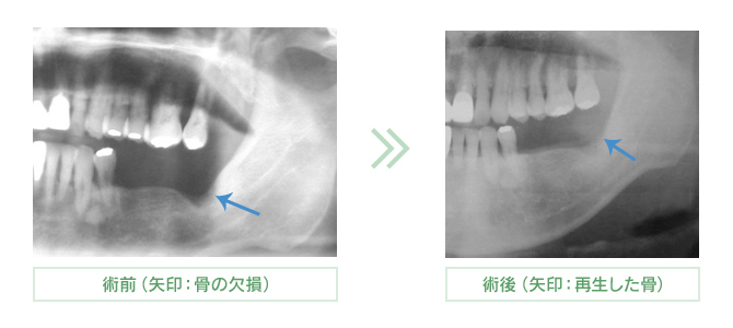 再生治療の症例写真